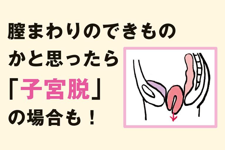 膣まわりのできものが、実は「子宮脱」だった!臓器脱をイラスト解説